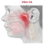 Viêm VA và vị trí của VA trên cơ thể